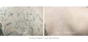 Tattoo Removal in Panama City, Florida at Sun Dermatology